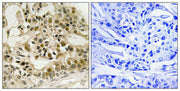 Immunohistochemistry analysis of paraffin-embedded human breast carcinoma tissue using Myb (Phospho-Ser532) antibody. The picture on the right is treated with the synthesized peptide.