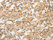 The image on the left is immunohistochemistry of paraffin-embedded Human thyroid cancer tissue using CSB-PA620044(STAM Antibody) at dilution 1/40, on the right is treated with fusion protein. (Original magnification: ×200)