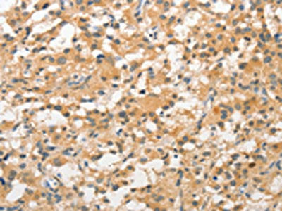 The image on the left is immunohistochemistry of paraffin-embedded Human thyroid cancer tissue using CSB-PA620044(STAM Antibody) at dilution 1/40, on the right is treated with fusion protein. (Original magnification: ×200)