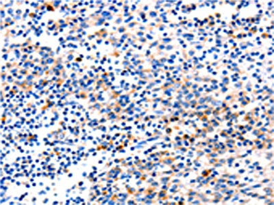 The image on the left is immunohistochemistry of paraffin-embedded Human tonsil tissue using CSB-PA620207(GADD45G Antibody) at dilution 1/120, on the right is treated with fusion protein. (Original magnification: ×200)