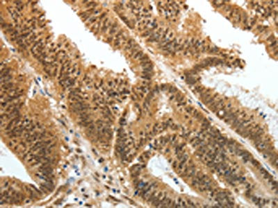 The image on the left is immunohistochemistry of paraffin-embedded Human colon cancer tissue using CSB-PA620246(PSMD3 Antibody) at dilution 1/25, on the right is treated with fusion protein. (Original magnification: ×200)