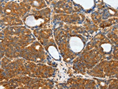 The image on the left is immunohistochemistry of paraffin-embedded Human thyroid cancer tissue using CSB-PA620256(RPS6KB1 Antibody) at dilution 1/25, on the right is treated with fusion protein. (Original magnification: ×200)