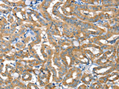 The image on the left is immunohistochemistry of paraffin-embedded Human thyroid cancer tissue using CSB-PA620280(TNFRSF21 Antibody) at dilution 1/20, on the right is treated with fusion protein. (Original magnification: ×200)