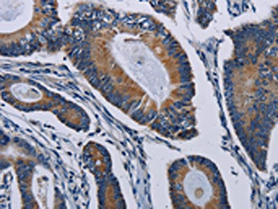 The image on the left is immunohistochemistry of paraffin-embedded Human colon cancer tissue using CSB-PA620323(PCDHAC2 Antibody) at dilution 1/50, on the right is treated with synthetic peptide. (Original magnification: ×200)