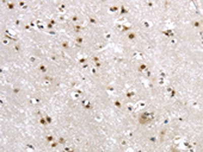 The image on the left is immunohistochemistry of paraffin-embedded Human brain tissue using CSB-PA620425(MRE11A Antibody) at dilution 1/20, on the right is treated with synthetic peptide. (Original magnification: ×200)