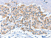 The image on the left is immunohistochemistry of paraffin-embedded Human breast cancer tissue using CSB-PA620593(APOBEC3D Antibody) at dilution 1/80, on the right is treated with synthetic peptide. (Original magnification: ×200)