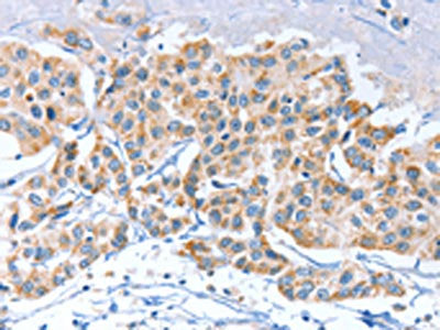 The image on the left is immunohistochemistry of paraffin-embedded Human breast cancer tissue using CSB-PA620593(APOBEC3D Antibody) at dilution 1/80, on the right is treated with synthetic peptide. (Original magnification: ×200)