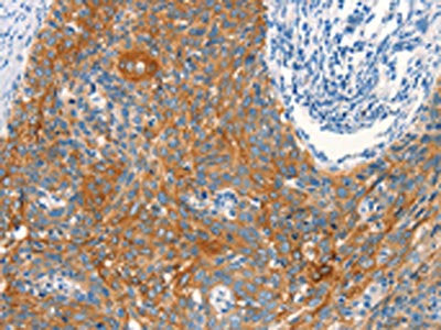 The image on the left is immunohistochemistry of paraffin-embedded Human cervical cancer tissue using CSB-PA620636(ARFGEF2 Antibody) at dilution 1/25, on the right is treated with synthetic peptide. (Original magnification: ×200)