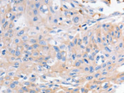 The image on the left is immunohistochemistry of paraffin-embedded Human cervical cancer tissue using CSB-PA620771(KCNA1 Antibody) at dilution 1/30, on the right is treated with synthetic peptide. (Original magnification: ×200)
