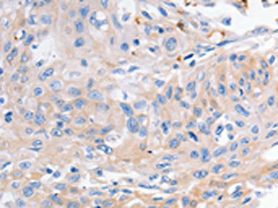 The image on the left is immunohistochemistry of paraffin-embedded Human cervical cancer tissue using CSB-PA620771(KCNA1 Antibody) at dilution 1/30, on the right is treated with synthetic peptide. (Original magnification: ×200)