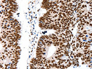 The image on the left is immunohistochemistry of paraffin-embedded Human colon cancer tissue using CSB-PA620805(LIFR Antibody) at dilution 1/15, on the right is treated with synthetic peptide. (Original magnification: ×200)