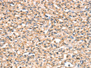 The image on the left is immunohistochemistry of paraffin-embedded Human prostate cancer tissue using CSB-PA620816(SLC32A1 Antibody) at dilution 1/20, on the right is treated with synthetic peptide. (Original magnification: ×200)