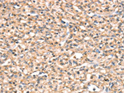 The image on the left is immunohistochemistry of paraffin-embedded Human prostate cancer tissue using CSB-PA620816(SLC32A1 Antibody) at dilution 1/20, on the right is treated with synthetic peptide. (Original magnification: ×200)