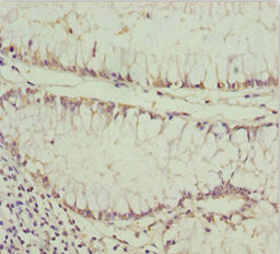 Immunohistochemistry of paraffin-embedded human colon cancer using CSB-PA620875ESR1HU at dilution of 1:100