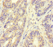 Immunohistochemistry of paraffin-embedded human colon cancer using CSB-PA620890LA01HU at dilution of 1:100