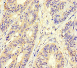 Immunohistochemistry of paraffin-embedded human colon cancer using CSB-PA620890LA01HU at dilution of 1:100