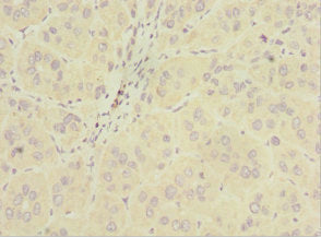 Immunohistochemistry of paraffin-embedded human liver cancer using CSB-PA620891ESR1HU at dilution of 1:100