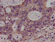 Immunohistochemistry of paraffin-embedded human colon cancer using CSB-PA620966LA01HU at dilution of 1:100