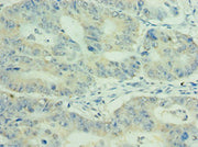 Immunohistochemistry of paraffin-embedded human colon cancer using CSB-PA620984ESR1HU at dilution of 1:100