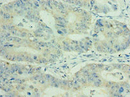 Immunohistochemistry of paraffin-embedded human colon cancer using CSB-PA620984ESR1HU at dilution of 1:100