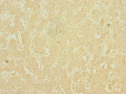 Immunohistochemistry of paraffin-embedded human liver cancer using CSB-PA621686EA01HU at dilution of 1:100