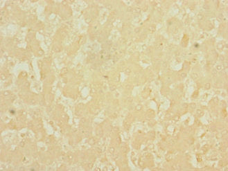 Immunohistochemistry of paraffin-embedded human liver cancer using CSB-PA621686EA01HU at dilution of 1:100