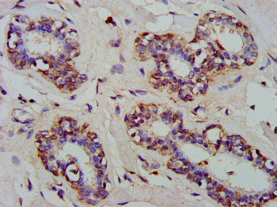 IHC image of CSB-PA621696LA01HU diluted at 1:300 and staining in paraffin-embedded human breast cancer performed on a Leica BondTM system. After dewaxing and hydration, antigen retrieval was mediated by high pressure in a citrate buffer (pH 6.0)....