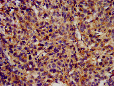 IHC image of CSB-PA621758LA01HU diluted at 1:300 and staining in paraffin-embedded human ovarian cancer performed on a Leica BondTM system. After dewaxing and hydration, antigen retrieval was mediated by high pressure in a citrate buffer (pH 6.0)....