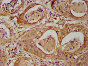 IHC image of CSB-PA621761LA01HU diluted at 1:500 and staining in paraffin-embedded human cervical cancer performed on a Leica BondTM system. After dewaxing and hydration, antigen retrieval was mediated by high pressure in a citrate buffer (pH 6.0)...