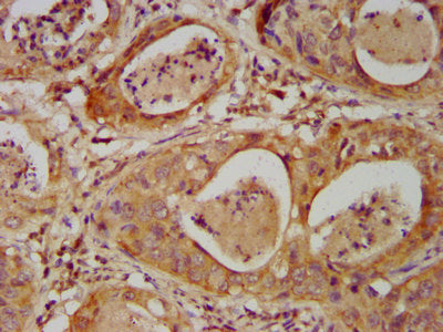 IHC image of CSB-PA621761LA01HU diluted at 1:500 and staining in paraffin-embedded human cervical cancer performed on a Leica BondTM system. After dewaxing and hydration, antigen retrieval was mediated by high pressure in a citrate buffer (pH 6.0)...