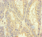 Immunohistochemistry of paraffin-embedded human endometrial cancer using CSB-PA621784LA01HU at dilution of 1:100