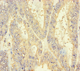 Immunohistochemistry of paraffin-embedded human endometrial cancer using CSB-PA621784LA01HU at dilution of 1:100