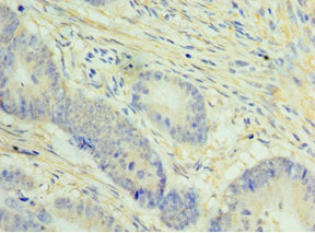 Immunohistochemistry of paraffin-embedded human colon cancer using CSB-PA621857DSR1HU at dilution of 1:100