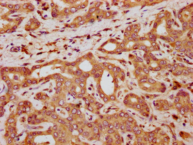 IHC image of CSB-PA621868LA01HU diluted at 1:300 and staining in paraffin-embedded human liver cancer performed on a Leica BondTM system. After dewaxing and hydration, antigen retrieval was mediated by high pressure in a citrate buffer (pH 6.0). S...