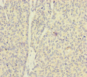Immunohistochemistry of paraffin-embedded human ovarian cancer using CSB-PA621875ESR1HU at dilution of 1:100