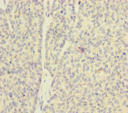 Immunohistochemistry of paraffin-embedded human ovarian cancer using CSB-PA621875ESR1HU at dilution of 1:100