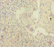 Immunohistochemistry of paraffin-embedded human lung cancer using CSB-PA621875ESR2HU at dilution of 1:100