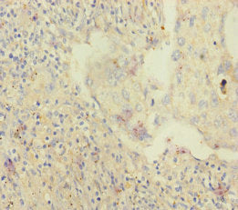 Immunohistochemistry of paraffin-embedded human lung cancer using CSB-PA621875ESR2HU at dilution of 1:100