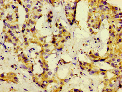 Immunohistochemistry of paraffin-embedded human liver cancer using CSB-PA621883LA01HU at dilution of 1:100