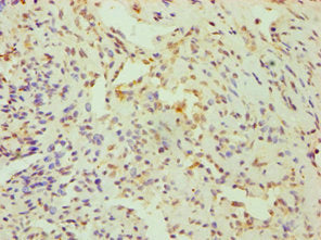 Immunohistochemistry of paraffin-embedded human breast cancer using CSB-PA621957DSR1HU at dilution of 1:100