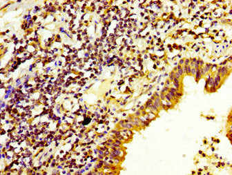IHC image of CSB-PA621973LA01HU diluted at 1:200 and staining in paraffin-embedded human lung cancer performed on a Leica BondTM system. After dewaxing and hydration, antigen retrieval was mediated by high pressure in a citrate buffer (pH 6.0). Se...