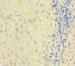 Immunohistochemistry of paraffin-embedded human liver cancer using CSB-PA621974HA01HU at dilution of 1:100