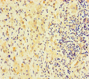 Immunohistochemistry of paraffin-embedded human lung cancer using CSB-PA622040LA01HU at dilution of 1:100