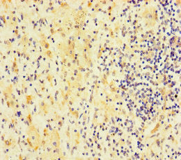 Immunohistochemistry of paraffin-embedded human lung cancer using CSB-PA622040LA01HU at dilution of 1:100