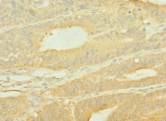 Immunohistochemistry of paraffin-embedded human endometrial cancer using CSB-PA622519LA01HU at dilution of 1:100