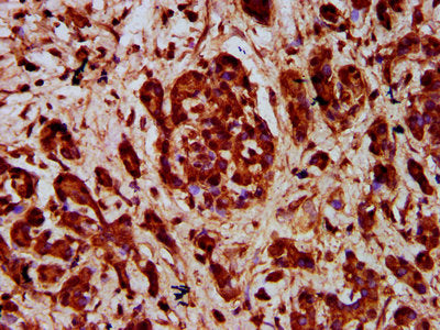 IHC image of CSB-PA622647LA01HU diluted at 1:400 and staining in paraffin-embedded human pancreatic cancer performed on a Leica BondTM system. After dewaxing and hydration, antigen retrieval was mediated by high pressure in a citrate buffer (pH 6....