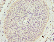 Immunohistochemistry of paraffin-embedded human cervical cancer using CSB-PA622649ESR2HU at dilution of 1:100