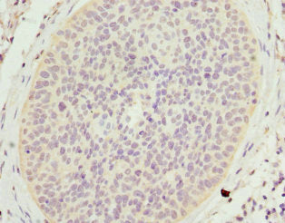 Immunohistochemistry of paraffin-embedded human cervical cancer using CSB-PA622649ESR2HU at dilution of 1:100