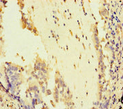 Immunohistochemistry of paraffin-embedded human lung cancer using CSB-PA622666LA01HU at dilution of 1:100