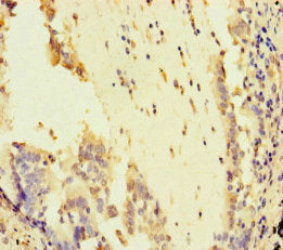 Immunohistochemistry of paraffin-embedded human lung cancer using CSB-PA622666LA01HU at dilution of 1:100